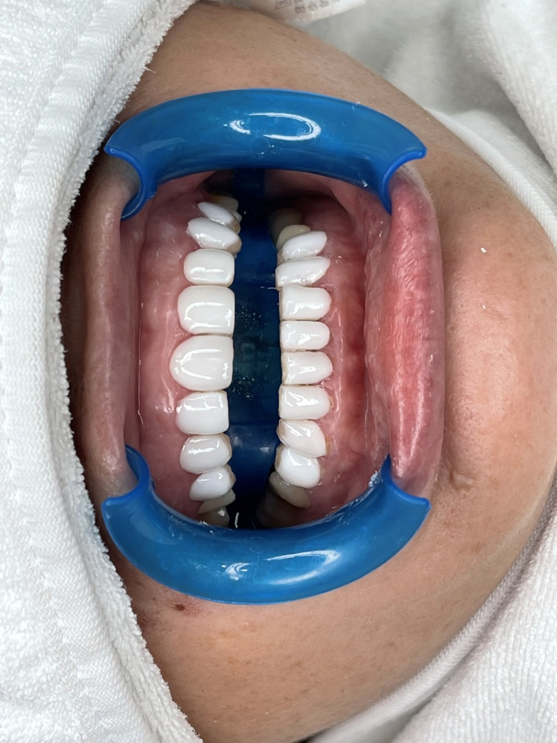 納米齒雕(牙齒美白)全瓷貼片